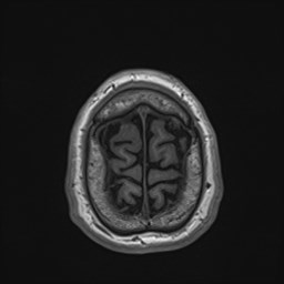 File:Cochlear incomplete partition type III associated with hypothalamic hamartoma (Radiopaedia 88756-105498 Axial T1 176).jpg