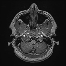Cochlear incomplete partition type III associated with hypothalamic hamartoma (Radiopaedia 88756-105498 Axial T1 40).jpg