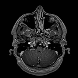 File:Cochlear incomplete partition type III associated with hypothalamic hamartoma (Radiopaedia 88756-105498 Axial T1 C+ 50).jpg
