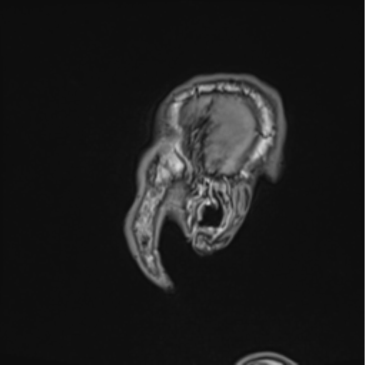 File:Colloid cyst of the third ventricle (Radiopaedia 86571-102662 Sagittal T1 4).png
