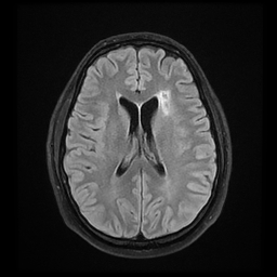 File:Colloid cyst with anterior communicating artery aneurysm (Radiopaedia 33901-35091 Axial FLAIR 15).jpg