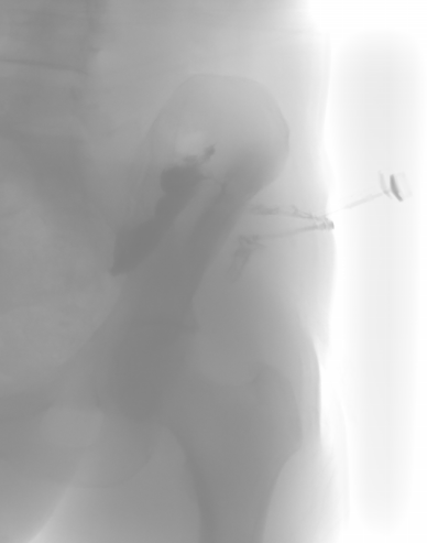 File:Colocutaneous fistula (Radiopaedia 71434-81774 AP negative image 1).PNG