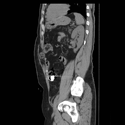 Colocutaneous fistula in Crohn's disease (Radiopaedia 29586-30093 F 34).jpg
