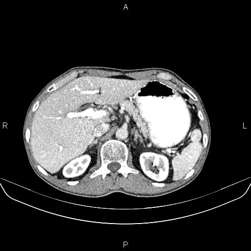 Colon adenocarcinoma - hepatic flexure (Radiopaedia 85635-101395 A 24).jpg