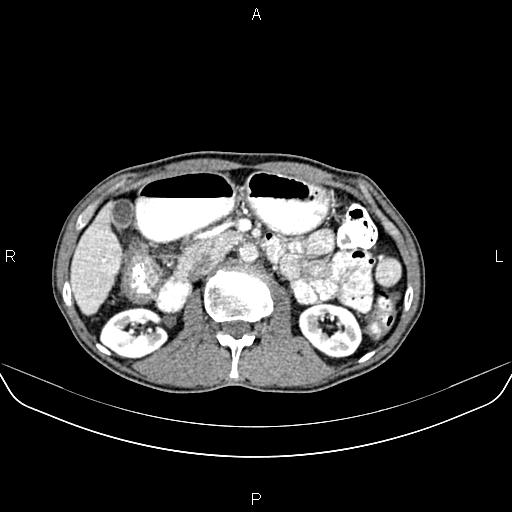 Colon adenocarcinoma - hepatic flexure (Radiopaedia 85635-101395 A 36).jpg