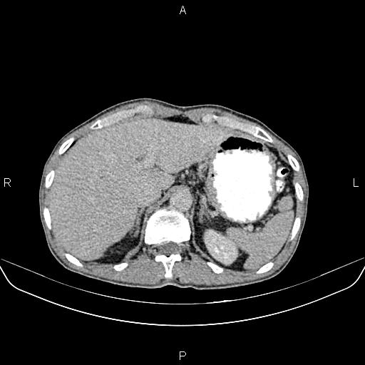File:Colon adenocarcinoma - hepatic flexure (Radiopaedia 85635-101395 Axial C+ delayed 19).jpg