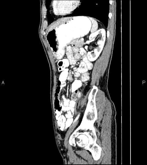 File:Colon adenocarcinoma - hepatic flexure (Radiopaedia 85635-101395 D 65).jpg