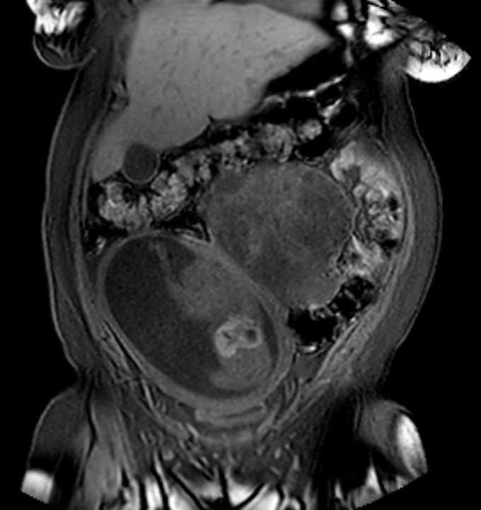 Colon adenocarcinoma with Krukenberg tumors, advanced pregnancy (Radiopaedia 67279-76645 E 21).jpg