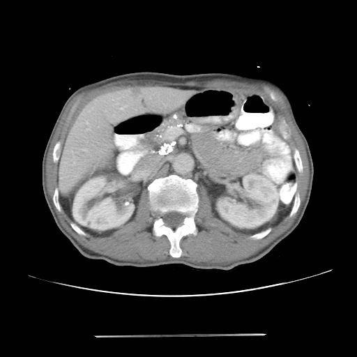 Colon cancer with calcified liver metastasis (Radiopaedia 74423-85307 A 27).jpg