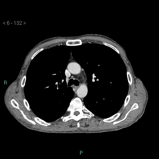 Colonic cancer (ultrasound and TC imaging) (Radiopaedia 50346-55713 B 132).jpg