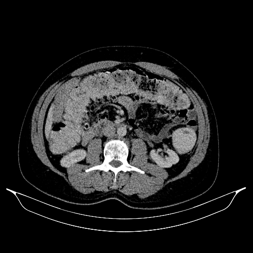 Colonic diverticulosis (Radiopaedia 72222-82744 A 3).jpg
