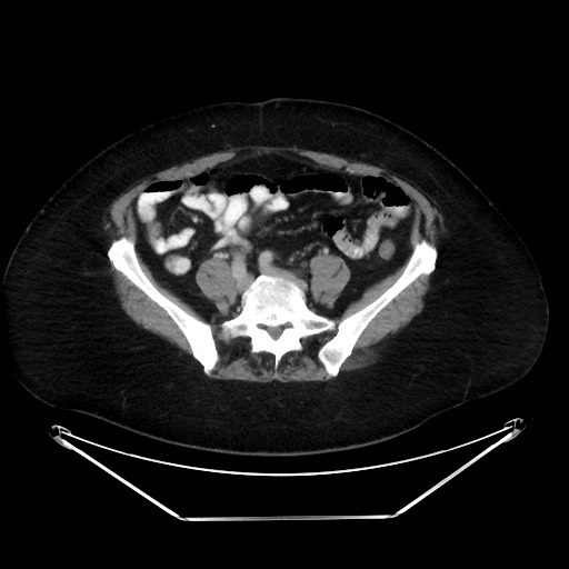 File:Colonic intussusception due to adenocarcinoma (Radiopaedia 86828-102987 A 103).jpg