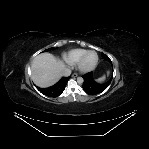 File:Colonic intussusception due to adenocarcinoma (Radiopaedia 86828-102987 Axial 135).jpg
