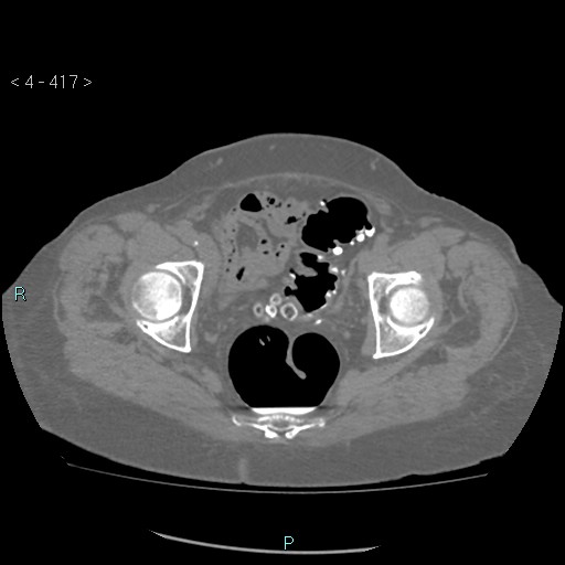 File:Colonic lipomas (Radiopaedia 49137-54244 Axial bone window 185).jpg