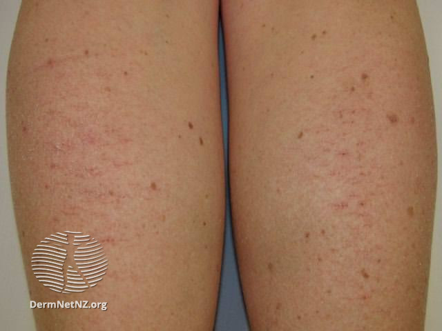 File:Eczema craquelé (DermNet NZ dermatitis-eczema-craquele3).jpg