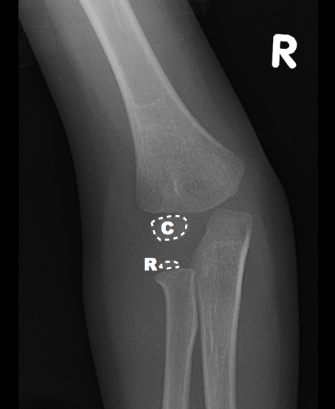 File:Elbow radiograph - age four (Radiopaedia 20905).png