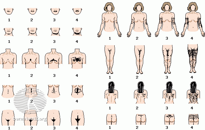 File:Ferriman-Gallwey visual scale for assessing hirsutism (DermNet NZ hair-nails-sweat-hirsutism-scale).gif