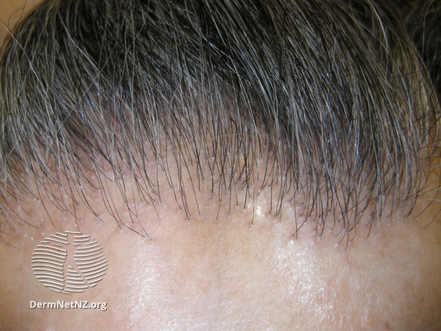 File:Frontal fibrosing alopecia (DermNet NZ hair-nails-sweat-ffa2).jpg