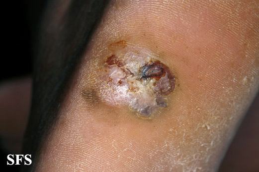 File:Melanoma (Dermatology Atlas 74).jpg