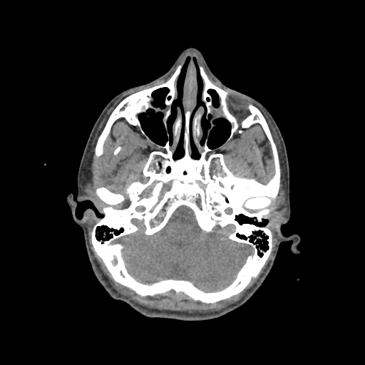 Nasal pyogenic granuloma (lobular capillary hemangioma) (Radiopaedia 85536-101244 Axial non-contrast 71).jpg