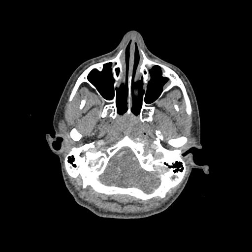 File:Nasal pyogenic granuloma (lobular capillary hemangioma) (Radiopaedia 85536-101244 C 61).jpg