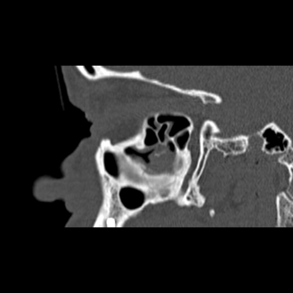 Nasal septal perforation (Radiopaedia 25030-25289 Sagittal bone window 8).jpg