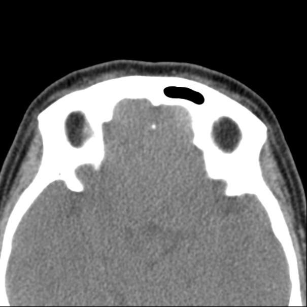 Nasolabial cyst (Radiopaedia 33987-35205 Axial non-contrast 45).jpg