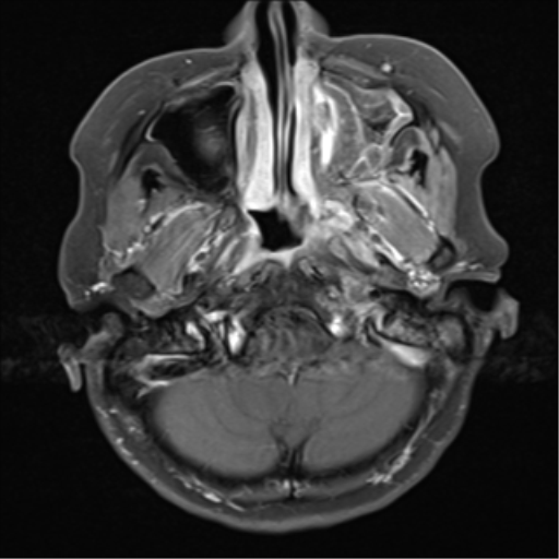 File:Nasopharyngeal carcinoma with cerebral abscess (Radiopaedia 43018-46273 Axial T1 C+ fat sat 17).png