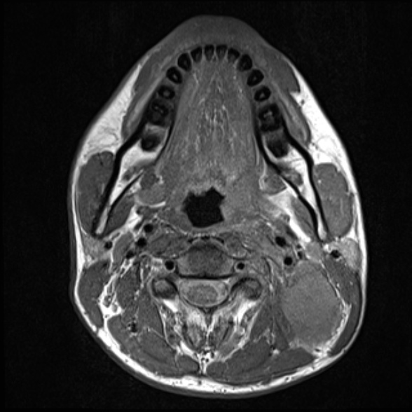 Nasopharyngeal carcinoma with skull base invasion (Radiopaedia 53415-59485 Axial T1 43).jpg