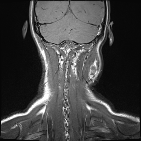 Nasopharyngeal carcinoma with skull base invasion (Radiopaedia 53415-59485 Coronal T1 2).jpg