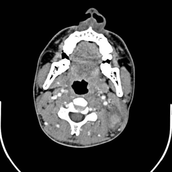 File:Nasopharyngeal carcinoma with skull base invasion (Radiopaedia 53415-59705 A 97).jpg