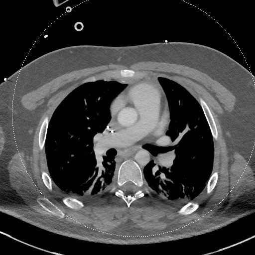 Neck CT angiogram (intraosseous vascular access) (Radiopaedia 55481-61945 B 21).jpg