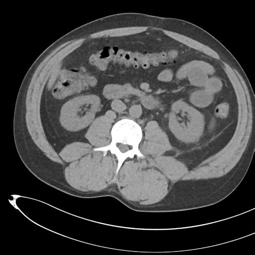 File:Necrotizing pancreatitis with acute necrotic collections (Radiopaedia 38829-41012 Axial non-contrast 42).png