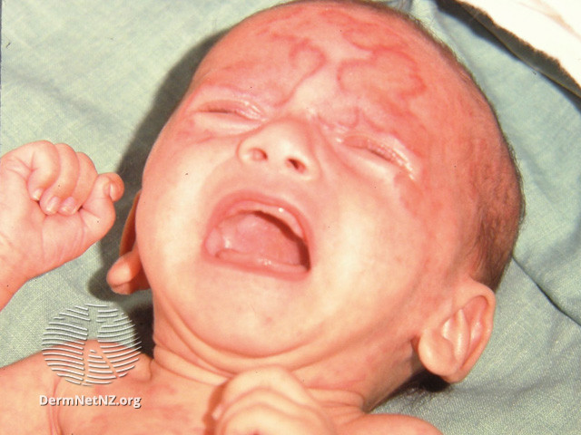 File:Neonatal lupus (DermNet NZ immune-lupus-neon3).jpg