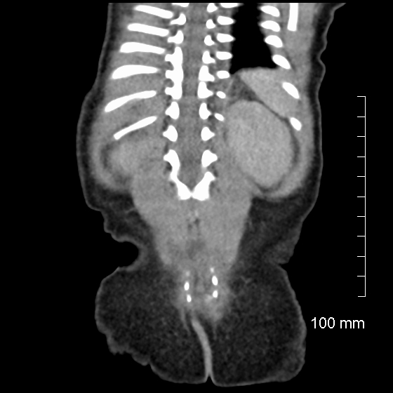 File:Neonatal neuroblastoma (Radiopaedia 56651-63438 Coronal non-contrast 43).jpg