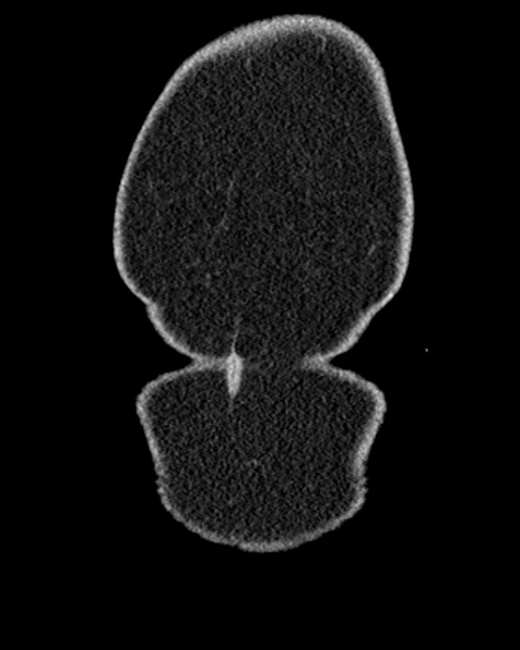 File:Nephrostomy for urosepsis (Radiopaedia 26180-26330 non-contrast 2).jpg