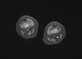 File:Neuroblastoma with bone metastases (Radiopaedia 67080-76414 Axial T1 C+ fat sat 12).jpg