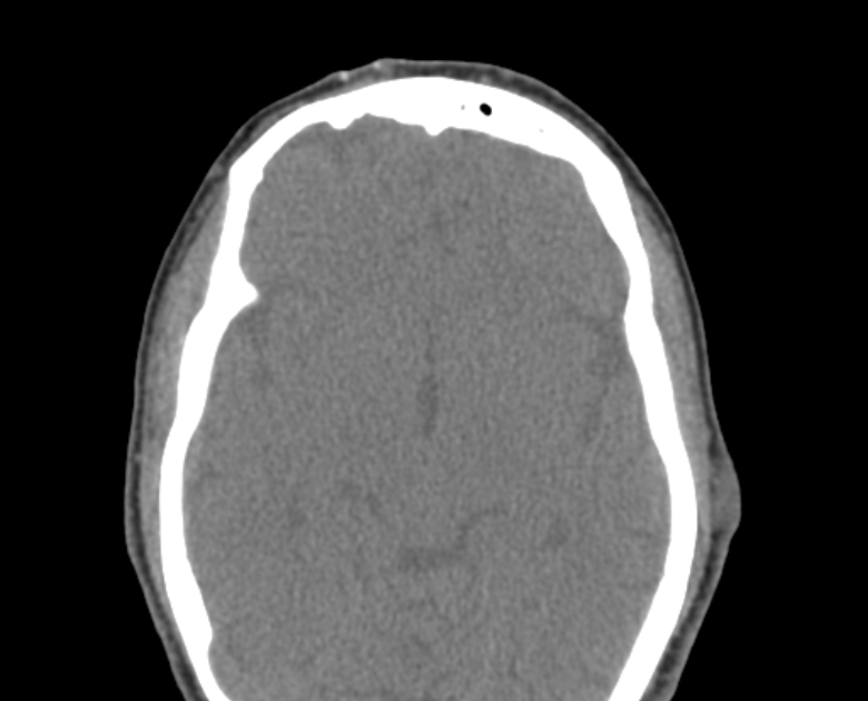 Neurofibromatosis type 1- orbital manifestations (Radiopaedia 49391-54511 Axial non-contrast 71).jpg