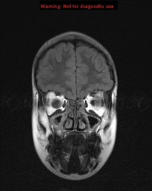 File:Neurofibromatosis type 1 with optic nerve glioma (Radiopaedia 16288-15965 Coronal FLAIR 21).jpg