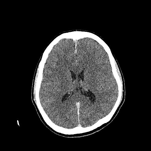 File:Neurofibromatosis type 2 (Radiopaedia 25389-25637 Axial C+ 56).jpg