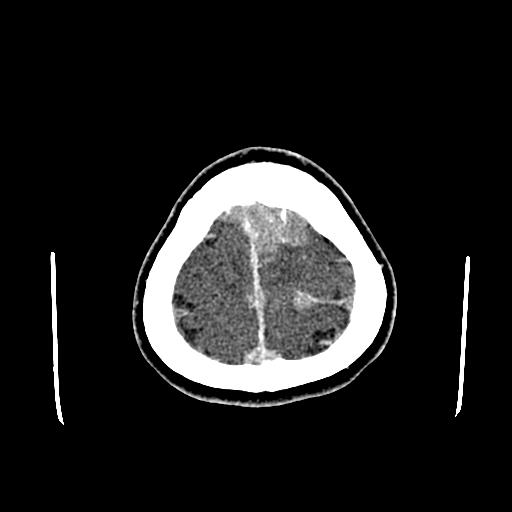 File:Neurofibromatosis type 2 (Radiopaedia 25389-25637 Axial C+ 93).jpg