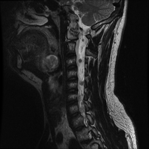 File:Neurofibromatosis type 2 (Radiopaedia 44936-48837 Sagittal T2 11).png