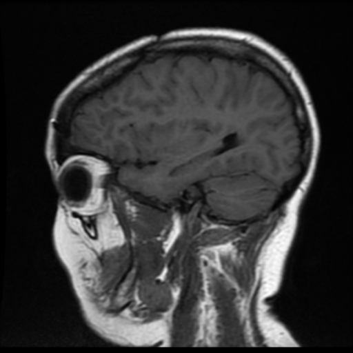 File:Neurofibromatosis type 2 (Radiopaedia 45229-49247 Sagittal T1 5).png