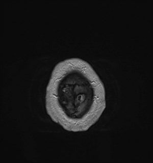 Neurofibromatosis type 2 (Radiopaedia 79097-92049 Axial T1 C+ 185).jpg
