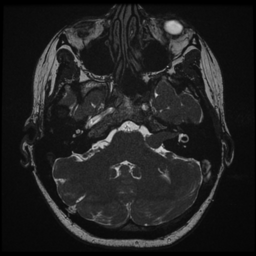 Neurofibromatosis type 2 - bilateral acoustic neuromata (Radiopaedia 40060-42566 Axial FIESTA 34).png