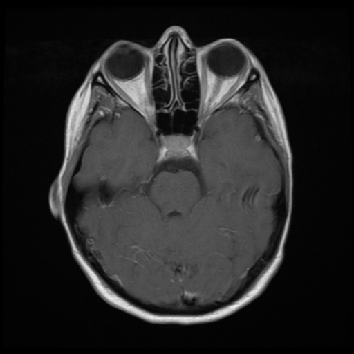 File:Neurofibromatosis type 2 - bilateral acoustic neuromata (Radiopaedia 40060-42566 Axial T1 C+ 7).png