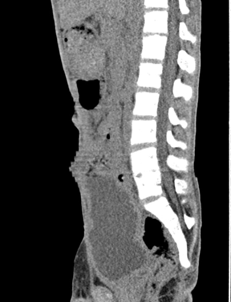 File:Neurogenic bladder (Radiopaedia 29058-29421 Coronal non-contrast 32).jpg