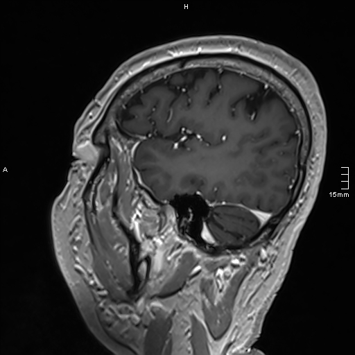 Neurosarcoidosis - involvement of the mesial temporal lobes (Radiopaedia 67429-76820 Sagittal T1 C+ 132).jpg
