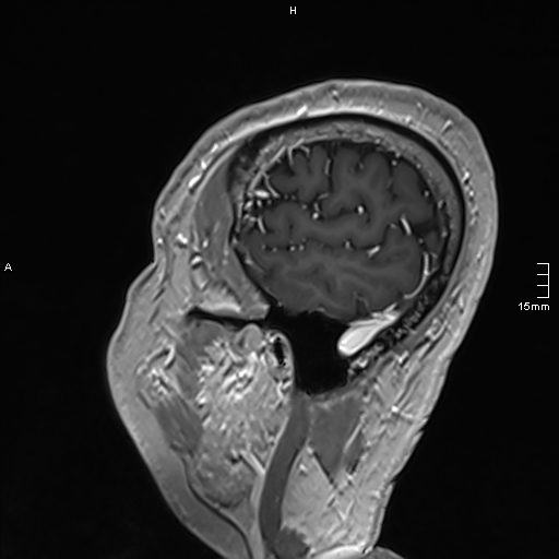 Neurosarcoidosis - involvement of the mesial temporal lobes (Radiopaedia 67429-76820 Sagittal T1 C+ 146).jpg