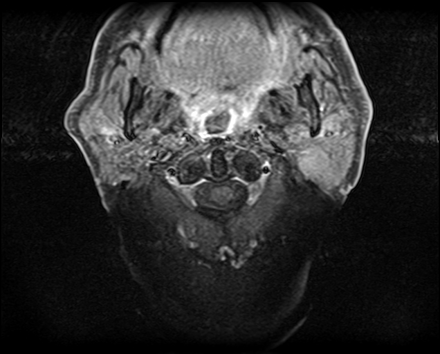 File:Non-Hodgkin lymphoma - parotid gland (Radiopaedia 71531-81890 Axial T1 C+ fat sat 14).jpg
